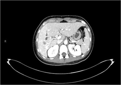 Case report: Diagnosis of NUT carcinoma of hepatic origin by next-generation sequencing